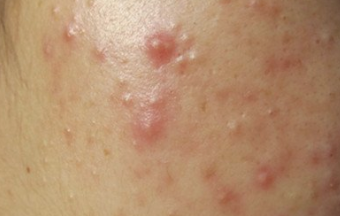博乐达超分子水杨酸在皮肤护理中的应用：给痘去根！