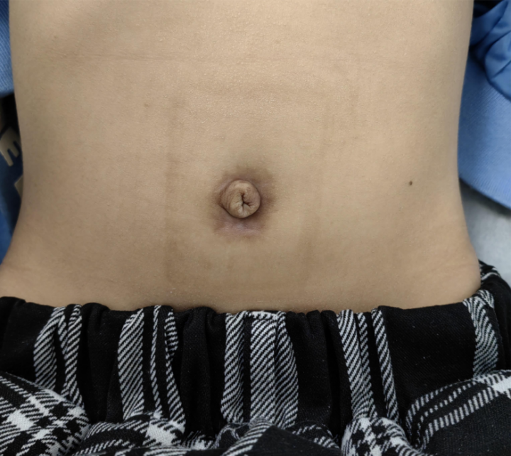 几近无痕！广州市妇女儿童医疗中心率先完成10台单孔机器人胆总管囊肿手术