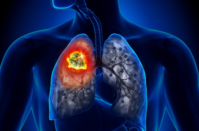 华夏源免疫细胞存储：肺癌会遗传和传染吗？肺癌误区需知晓！