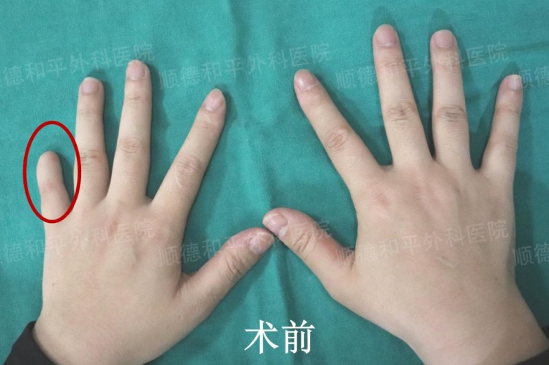 真实手指再造案例:手指断了可“再生”,佛山医生手指再造技术牛