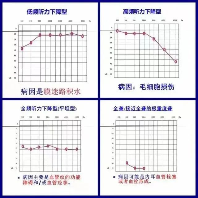 突发性耳聋能治好吗？成都民生耳鼻喉医院治疗效果好，百姓信任！