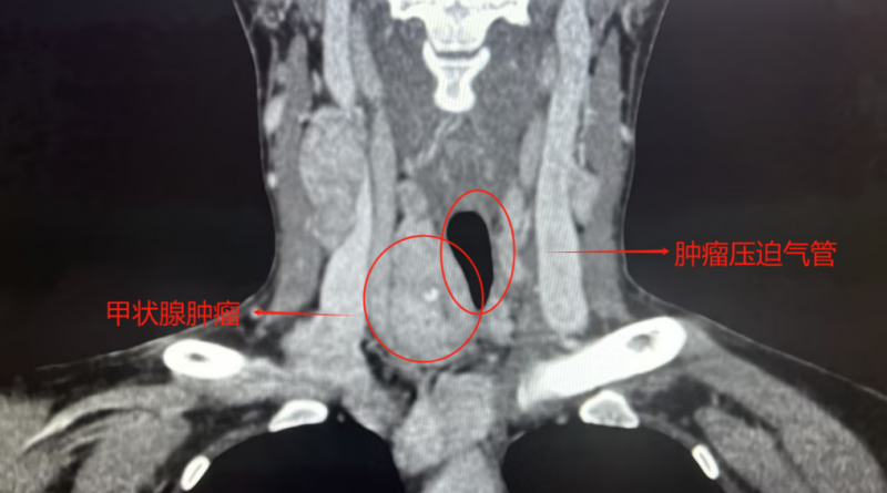 米诺娃朱精强教授团队成功完成一例甲状腺癌局部晚期高难度手术