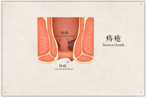 【北京丰益肛肠医院】外翻的菊花？不，这是“嵌顿痔”！