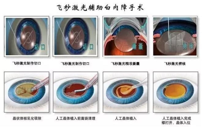 一次解决老花、近视、远视、散光、白内障：飞秒老花矫正手术带来视力"新生"(图3)