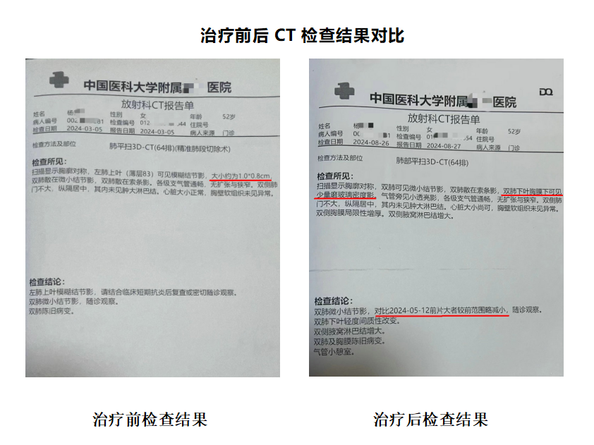 知名肿瘤专家张文彭医生擅用菌药抗肿瘤 磨玻璃肺结节20天消失