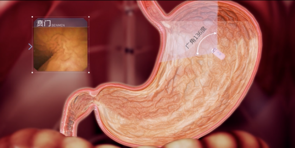 青海东大肛肠医院看胃病怎么样？磁控胶囊胃镜来帮你！
