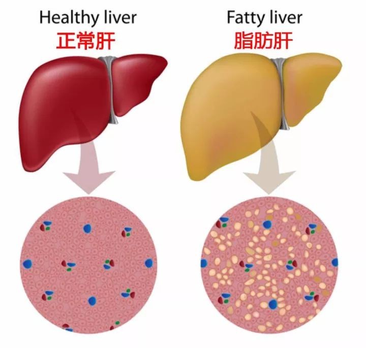 肝癌风险可逆转？LAIFE「乐轻肝」揭秘预防之道！