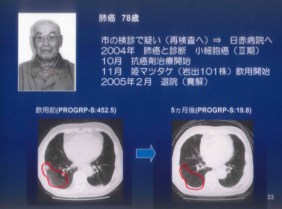 全球肺癌治疗新希望——蘑菇精CP-101的突破性进展