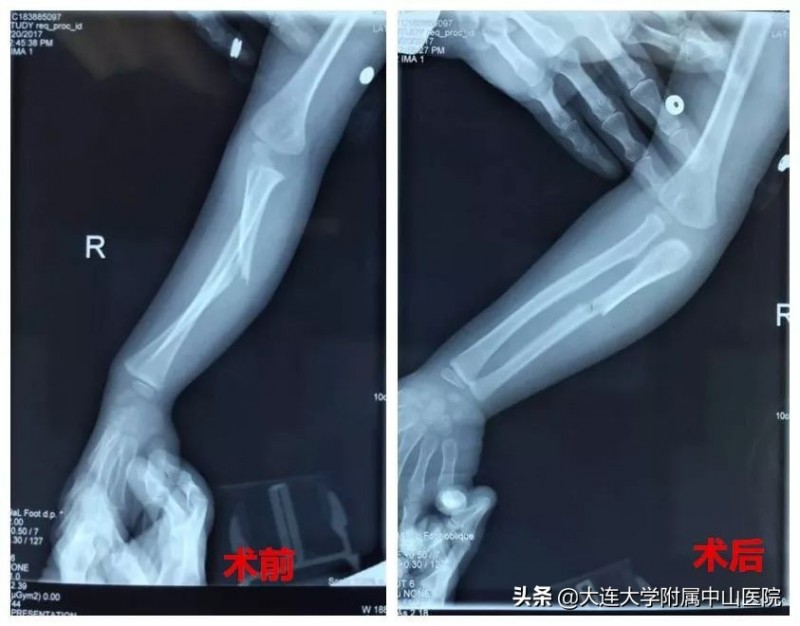 《ACC 钙：骨折骨裂人群的康复新希望》