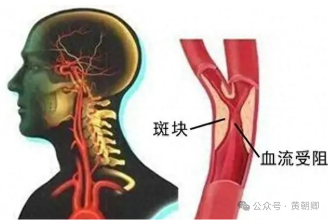 醫學論文證實：步長青花瓷腦心通膠囊可延緩頸動脈斑塊進展