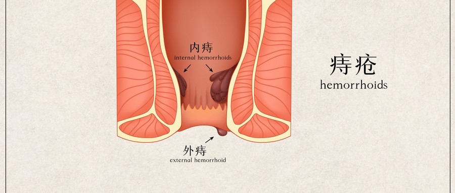 【柳州痔疮医院排名】为什么你会得内痔？原因竟如此多样