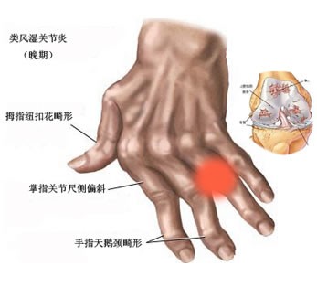 与类风湿性关节炎有关的维生素D