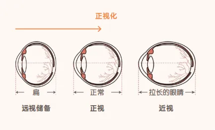 三维一体近视管理｜福州普瑞眼科专家：孩子近视的几个阶段，早了解早预防！