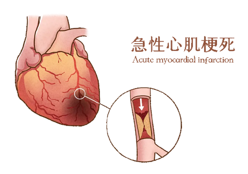 寒潮来临心脑血管疾病高发，怎么做好预防保护血管健康